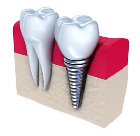 протезирование зубов металлокерамика