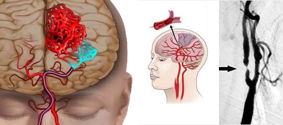 ишемия головного мозга 