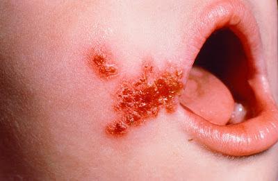 Staphylococcus aureus что это такое у ребенка 2 года thumbnail