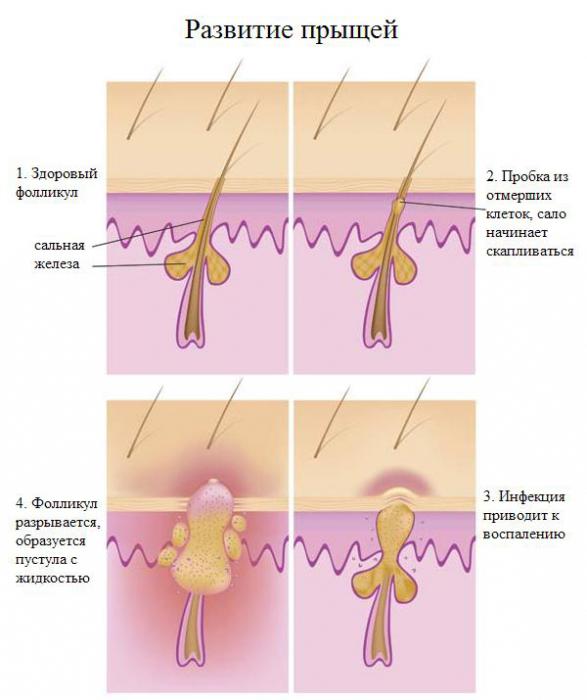 как избавиться от угрей