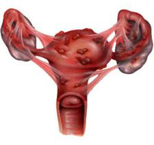 дюфастон для зачатия при эндометриозе