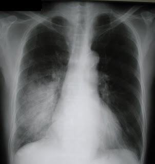 Пневмония легких