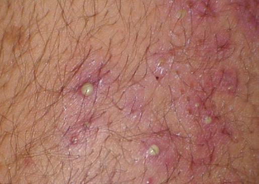 стафилококковая инфекция кожи