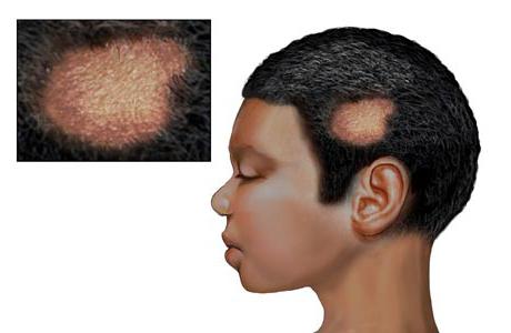 микроспория волосистой части головы 