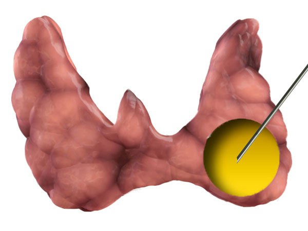 тонкоигольная аспирационная биопсия щитовидной железы