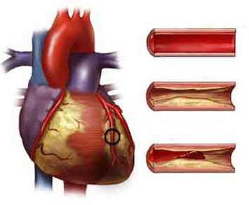 атеросклероз арты сердца