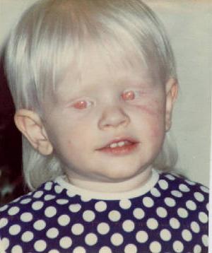люди с красными глазами альбиносы