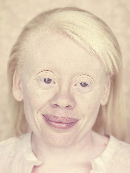 глаза альбиноса человека