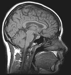компью терная томография головного мозга