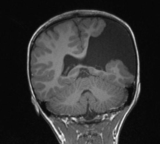 магнитно резонансная томография головного мозга