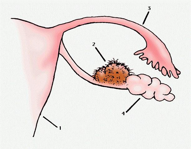 Как проходит операция при дермоидной кисты яичника thumbnail
