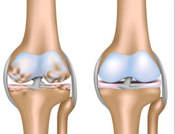 деформирующий остеоартроз коленного сустава 