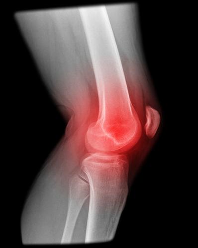 остеоартроз коленного сустава мкб 10 