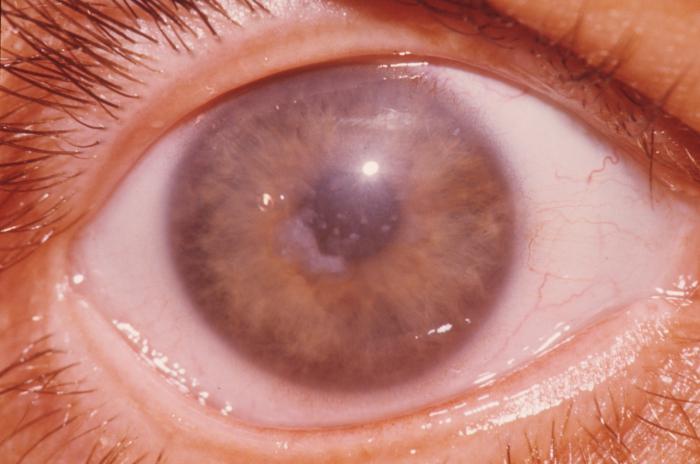Болезни роговицы глаза симптомы thumbnail