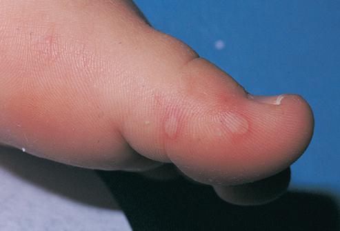У ребенка на большом пальце ноги пузыри под кожей thumbnail