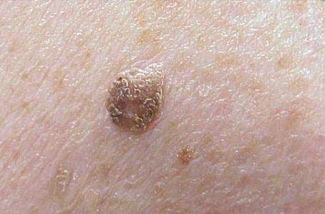 Себорейный кератоз кожи лечение народными средствами thumbnail