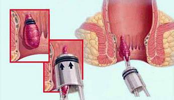 латексное легирование геморроидальных узлов