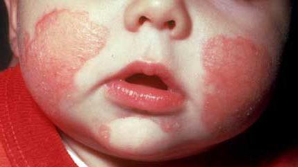 кожный дерматит на лице