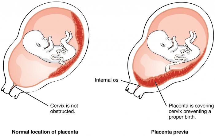 низкое расположение плаценты при беременности 20 недель