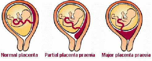 низкое расположение плаценты при беременности 22 недели