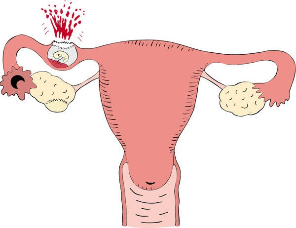 как определить внематочную беременность