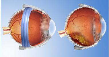Отслойка сетчатки глаза лечение