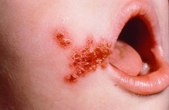 бактериальные заболевания кожи