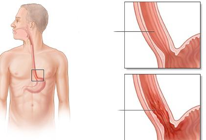 эрозивный эзофагит симптомы