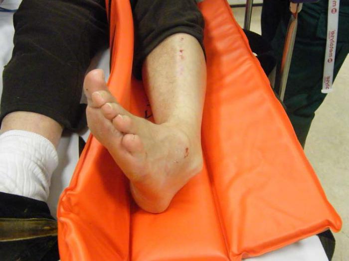 Правильное лечение перелома ноги thumbnail