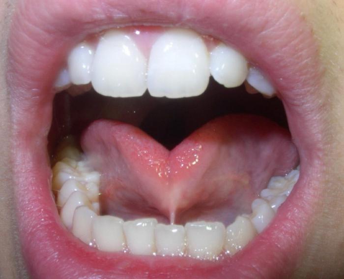 подрезание уздечки губы