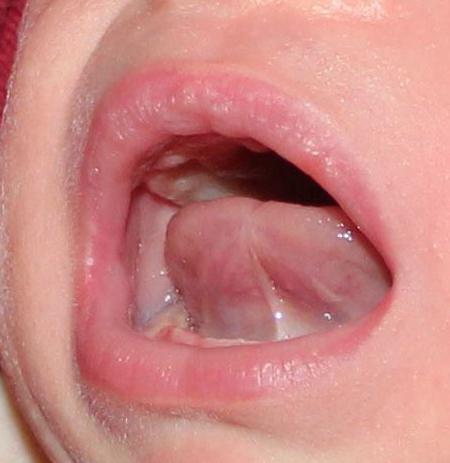 подрезание уздечки языка у детей