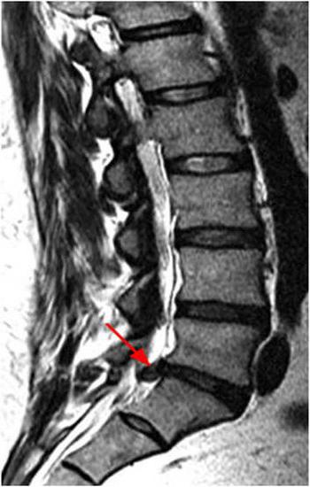 синдромы поясничного остеохондроза