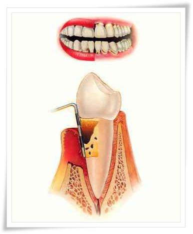 хронический периодонтит лечение