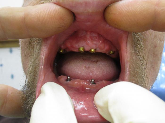 Имплантация зубов клиника