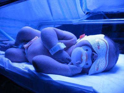 желтушка у новорожденного фото