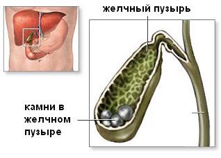 калькулезный холецистит меню