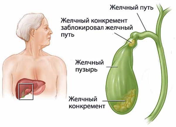 калькулезный холецистит