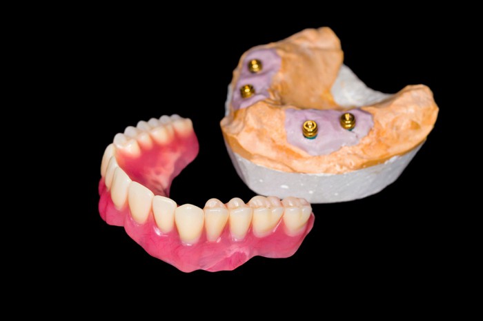 покрывные зубные протезы