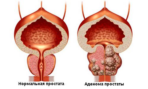 Лечение аденомы предстательной железы без операции