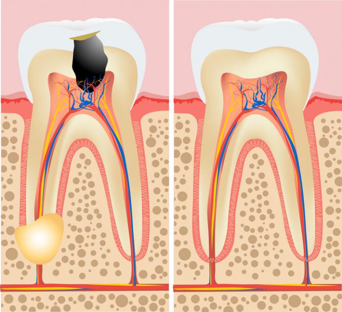 гранулема на корне зуба фото