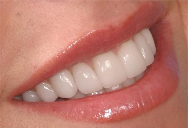 стоимость металлокерамики зубов