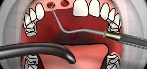 альвеолит после удаления зуба 