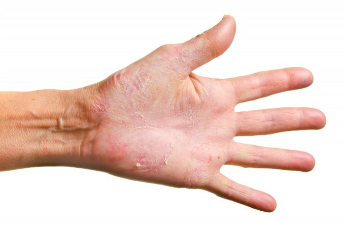 грибок на коже рук