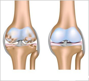 коленный сустав лечение без операции 
