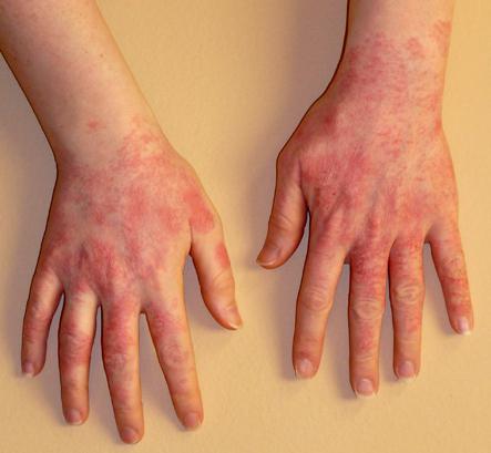 Пищевая аллергия у детей осложнения thumbnail