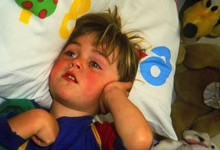Последствия аллергии у детей пищевой thumbnail