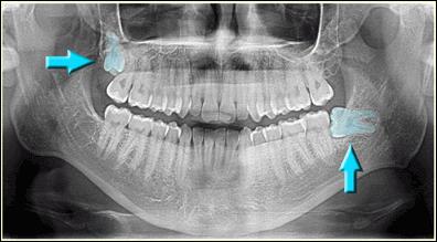 рентген снимки зубов