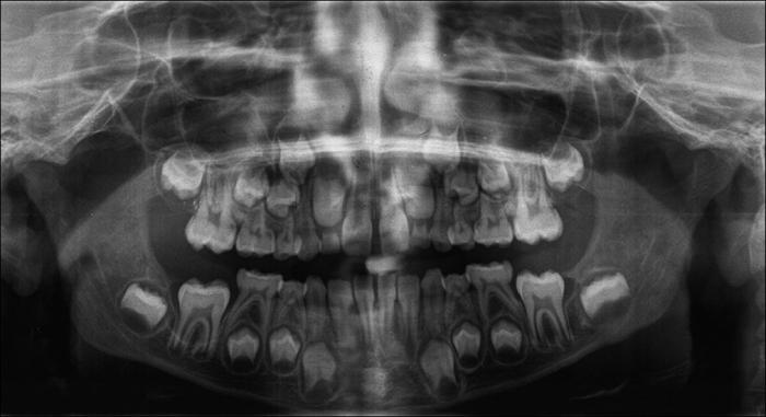 рентген молочных зубов