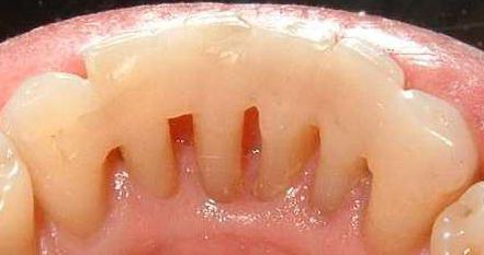 стоматологические болезни десен