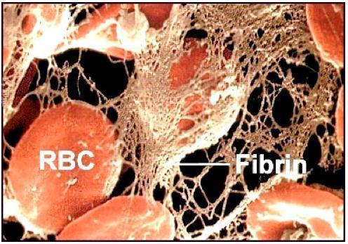 причины повышенного фибриногена в крови